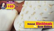 Clean Blackheads and Acne Hidden under skin - Acne Treatment (#69)