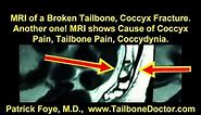 MRI of Broken Tailbone, Coccyx Fracture. See what the Radiologist missed!