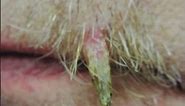 Cutaneous🎷 Horn 🎺 Evaluation 🔬 & Treatment🔪 at Las Vegas Dermatology turns out to be a Trichilemmoma