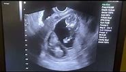 Twins at 12 weeks gestation!