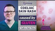 Dermatitis Herpetiformis: Skin Rash Linked To Coeliac Disease [Celiac] And Gluten Intolerance