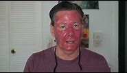 My Face is Coming Off! -- A Fluorouracil Skin Cancer Diary (Efudex)