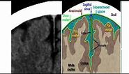 Basics of brain CT scan part I