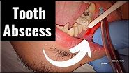 Incision and Drainage of Tooth Abscess Draining Pus • Video • MEDtube.net