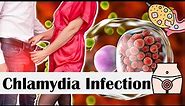 Chlamydia Infection - Causes, Risk Factors, Transmission, Signs & Symptoms, Diagnosis & Treatment