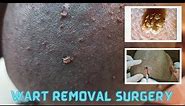 Wart removal by laser/cautery @DrArifMDDermatologist #wartstreatment #skin #dermatology #skintreatment