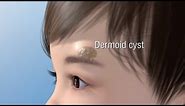Dermoid Cyst Ablation
