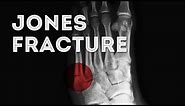 jones fracture