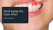 Hard Lump On Gum After Tooth Extraction: What You Should Do?