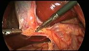 Laparoscopic Cholecystectomy (Gallbladder) Surgery