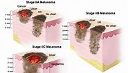 Understanding Melanoma: Treatment Options for Stage II Melanoma