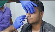 Rhinoplasty Before and After - Rhinoplasty | Nose Job Before After Experience - Dr. Sunil Richardson