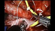 Single-Port Robotic-Assisted Extraperitoneal Kidney Transplantation (Graphic)