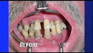 Teeth ~ No Dentures Dental Implants - Living Healthy Chicago