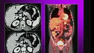 Overview of Pancreatic Imaging CT and MR