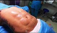 Marcacion Atletica en Hombre -abdominal lipomarcacion in man 4K