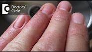 How to treat Contact Dermatitis on fingertips? - Dr. Aruna Prasad