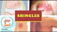 What Causes Shingles? Pictures, Signs, Symptoms, Treatment of Herpes Zoster Shingles Virus
