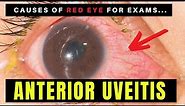 Causes of Red Eye - Part 2: ANTERIOR UVEITIS (Iritis)