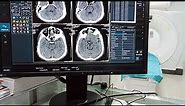 CT Scan of Brain Sagittal & Coronal Reconstruction image Hitachi Machine