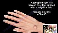 What Is A Ganglion Cyst - Everything You Need To Know - Dr. Nabil Ebraheim