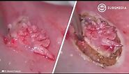 Squamous Papillary Lesion of the Oral Mucosa: Management with Diode Laser and Operative Microscope