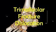 Trimalleolar Ankle Fracture Dislocation Reduction