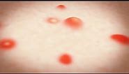 What Is Shingles? - Inside Health