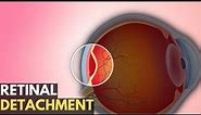Retinal Detachment: Everything You Need To Know