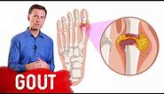 The 7 Natural Remedies for Gout