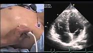 Intro to Echo Apical 4 Chamber View.mov