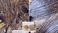 Little girl suffered head lice for three years horrifying new video reveals – with millions of the bugs c