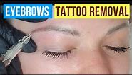How to remove PMU eyebrows. Eyebrow Tattoo Removal (full procedure)