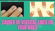 Causes Of Vertical Lines On Your Nails and What to Do About It - Nuse Healthy