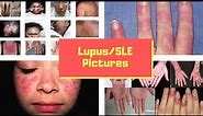 Lupus Pictures - Symptoms, images, Photos, Pictures of Lupus Rash - SLE Disease in Men, Women