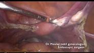 Adnextomy for borderline ovarian tumor • Video • MEDtube.net