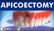 Apicoectomy - Treatment of root canal infection ©