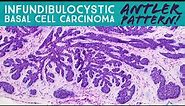 Infundibulocystic Basal Cell Carcinoma (BCC w/ follicular differentiation): Dermpath in 5 Minutes