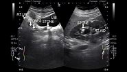 Ultrasound Video showing a renal stone with multiple ureteric stones.