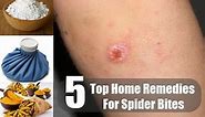 5 Home Remedies for Spider Bites | By Top 5.