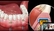 Dental Implant Overdenture | Snap-In Dentures