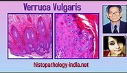 Pathology of Verruca Vulgaris (Common Wart) - Dr Sampurna Roy MD ( dermpath, dermatopathology)