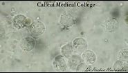Urine Microscopy- Glitter cells