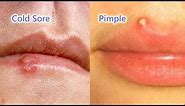 Pimple vs. Cold Sore: The Differences, Identification and Treatment