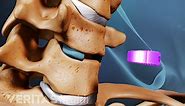 ACDF: Anterior Cervical Discectomy and Fusion