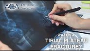 AOA Orthopedic Specialists - Tibial Plateau Fracture