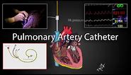 Pulmonary artery catheter (Swan-Ganz Catheter) placement and physiology