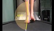 Over Pronation and how this is measured in walking