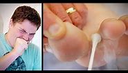 OUCH! FREEZING BIG WARTS BETWEEN TOES (with liquid nitrogen) | Dr. Paul