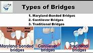 Types Of Dental Bridges